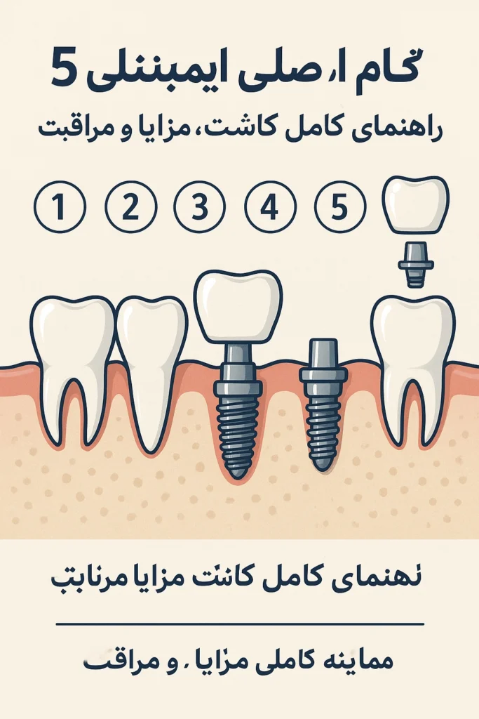 ایمپلنت دندان